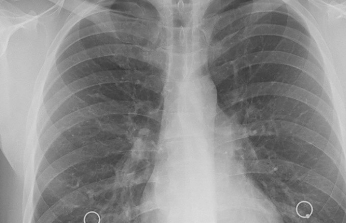 Akciğer Kanseri Belirtileri Nelerdir: 6 Yaygın Görülen Belirti!